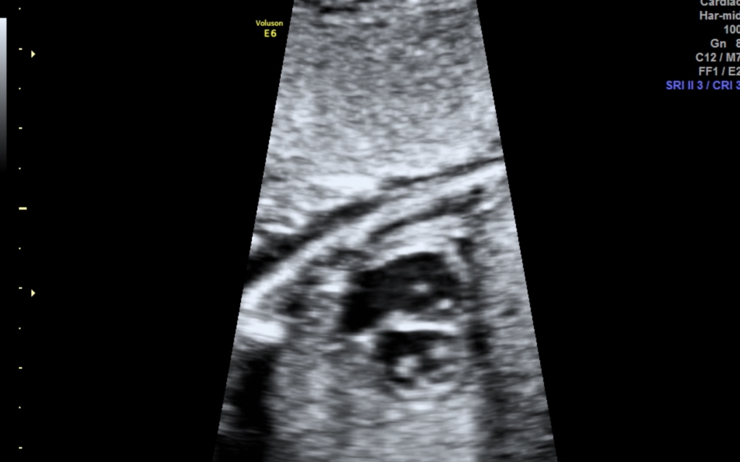 Εξεταση Καρδιας Εμβρυου 2ου τριμηνου